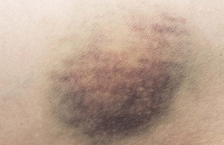 Bruising on your legs