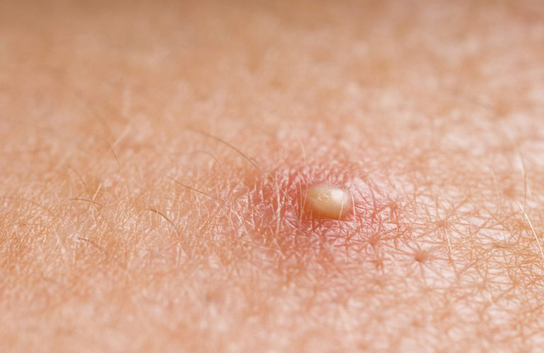 Clear up pimples
