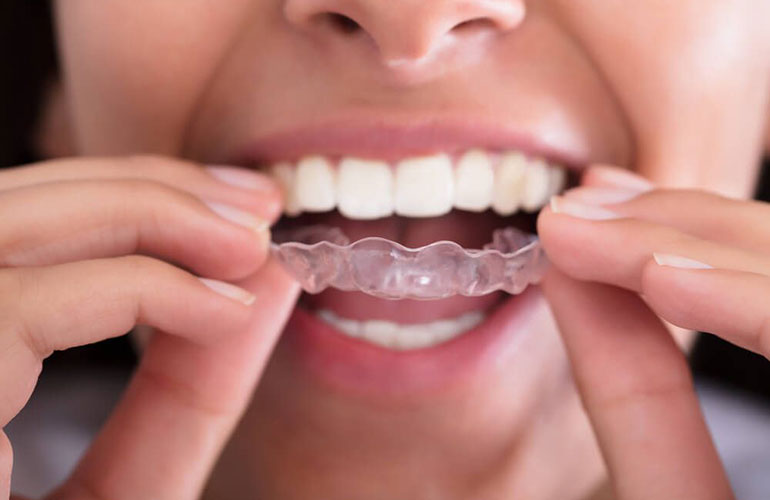 DIY orthodontics