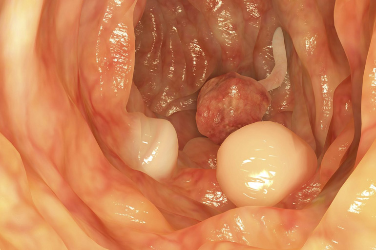 How serious are polyps?