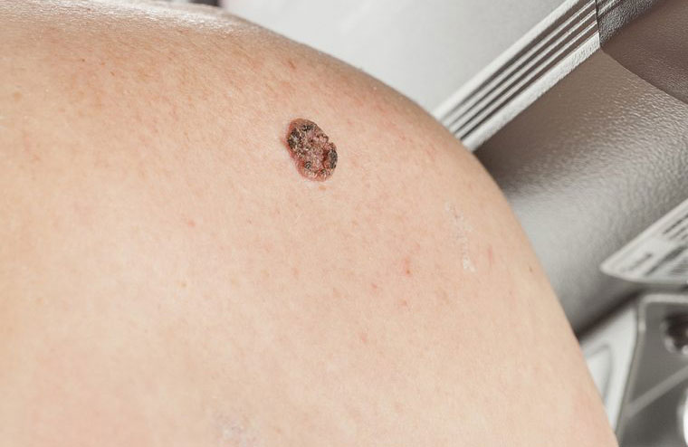 “I had a scab that wouldn’t heal”