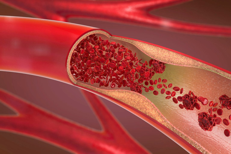 What is a blood clot?