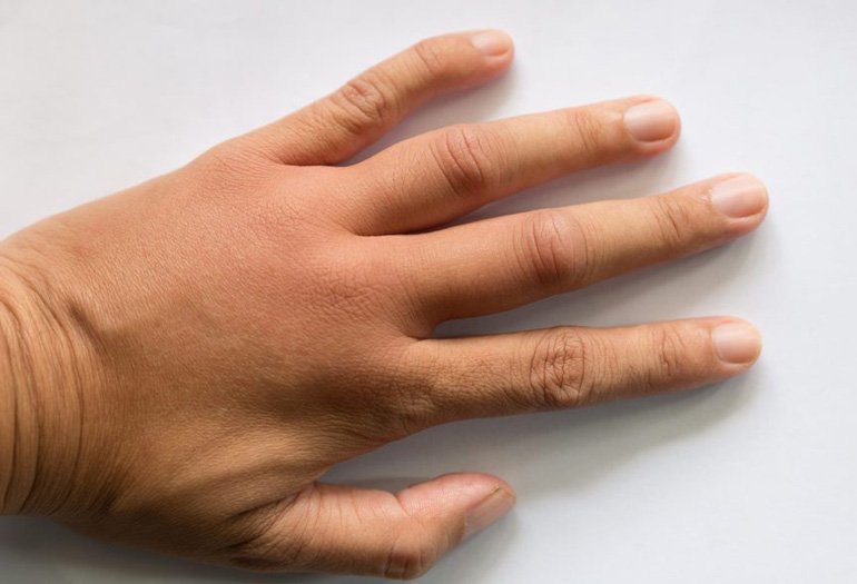 Swelling