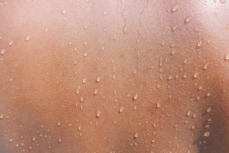 Excessive sweating