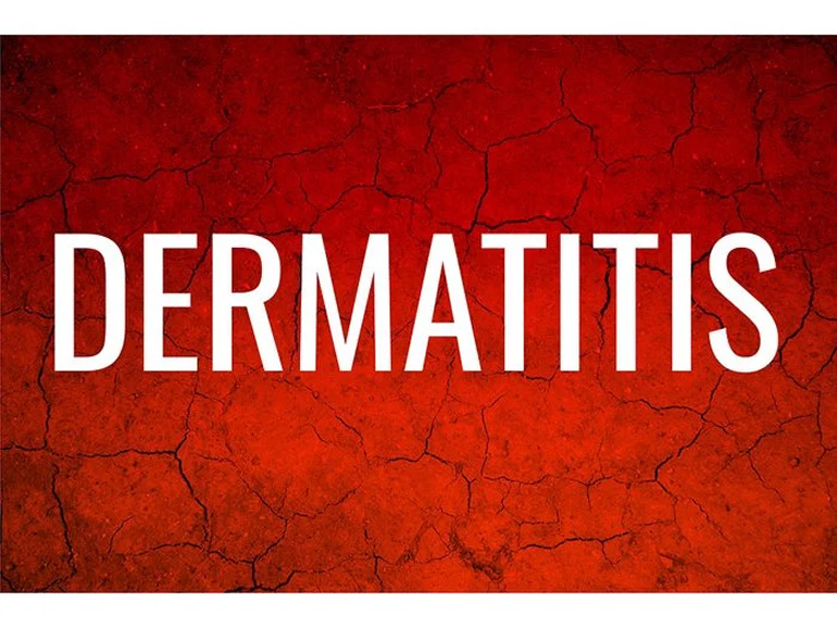 Contact Dermatitis