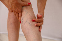 12 Simple Ways to Improve Circulation and Prevent Varicose Veins